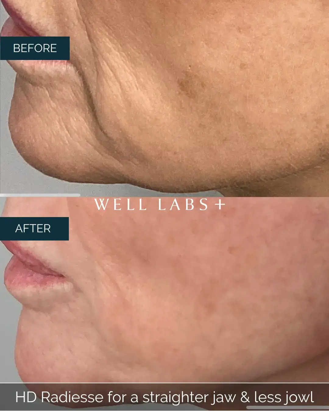 Before and after HD Radiesse for a straighter jaw & less jowl at Well Labs+ Dallas, showing the treated jawline