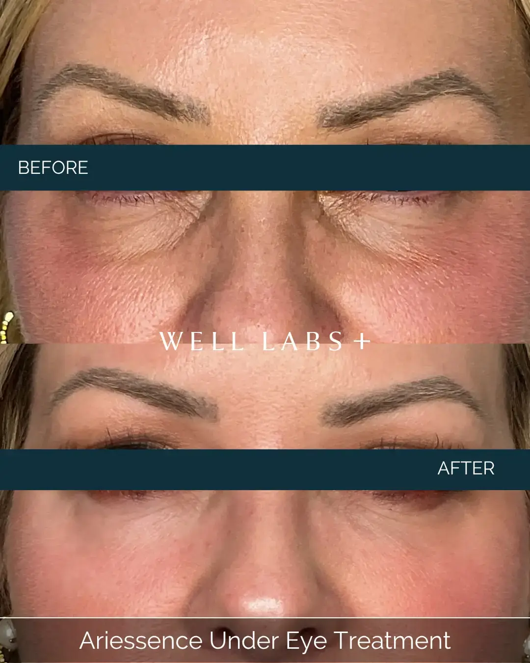 Before and after Ariessence Under Eye Treatment at Well Labs+ Dallas, showing the treated under-eyes