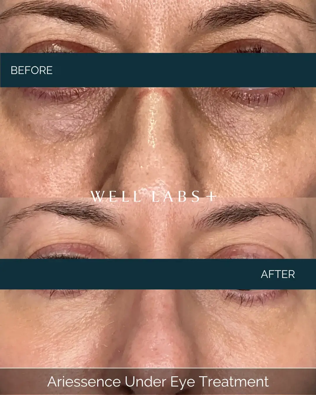 Before and after Ariessence Under Eye Treatment at Well Labs+ Dallas, showing the treated under-eyes