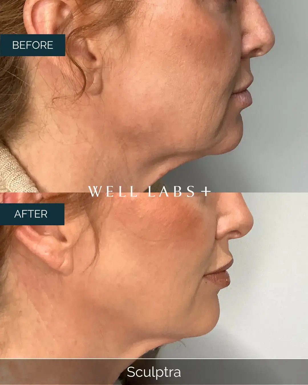 Before and after Sculptra at Well Labs+ Dallas, showing the treated cheeks