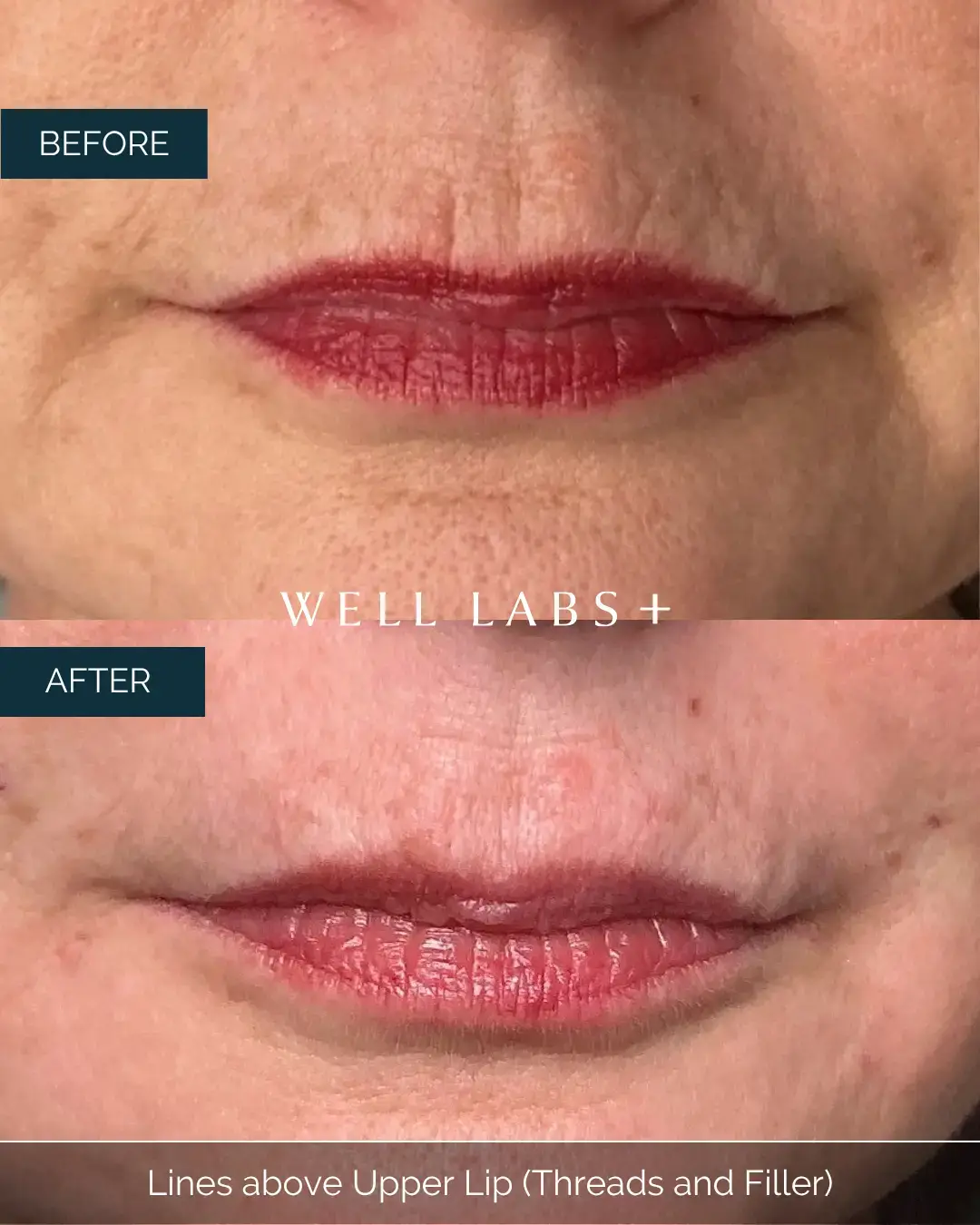 Before and after Lines above Upper Lip (Threads and Filler) at Well Labs+ Dallas, showing the treated upper lip