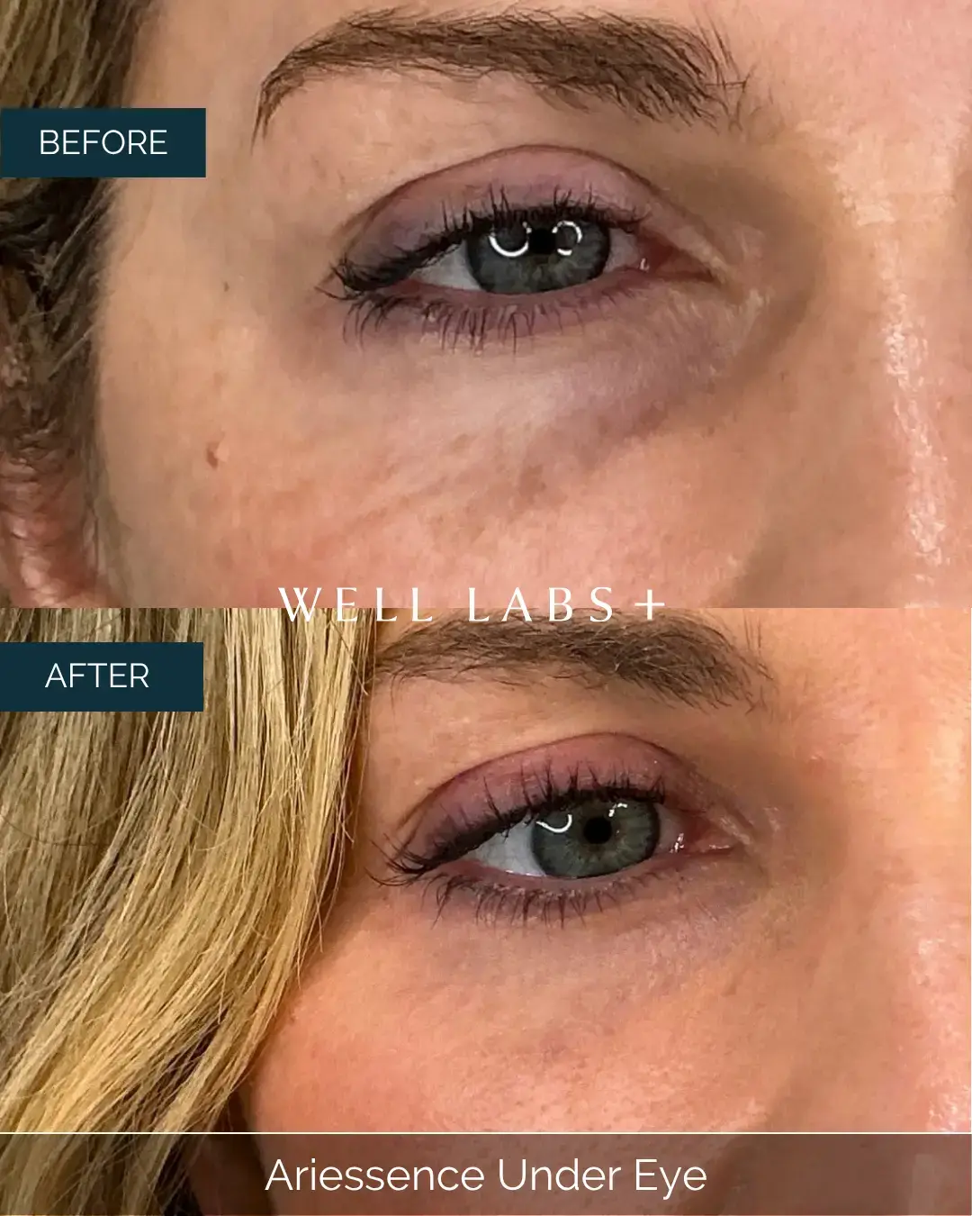 Before and after Ariessence Under Eye at Well Labs+ Dallas, showing the treated under-eyes
