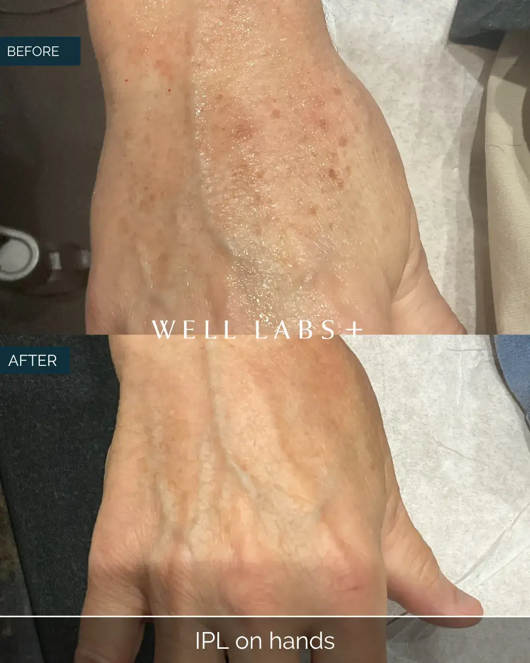 Before and after IPL on hands at Well Labs+ Dallas, showing the treated hands