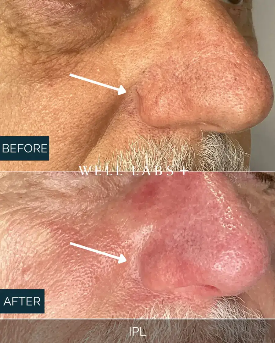 Before and after IPL at Well Labs+ Dallas, showing the treated nose