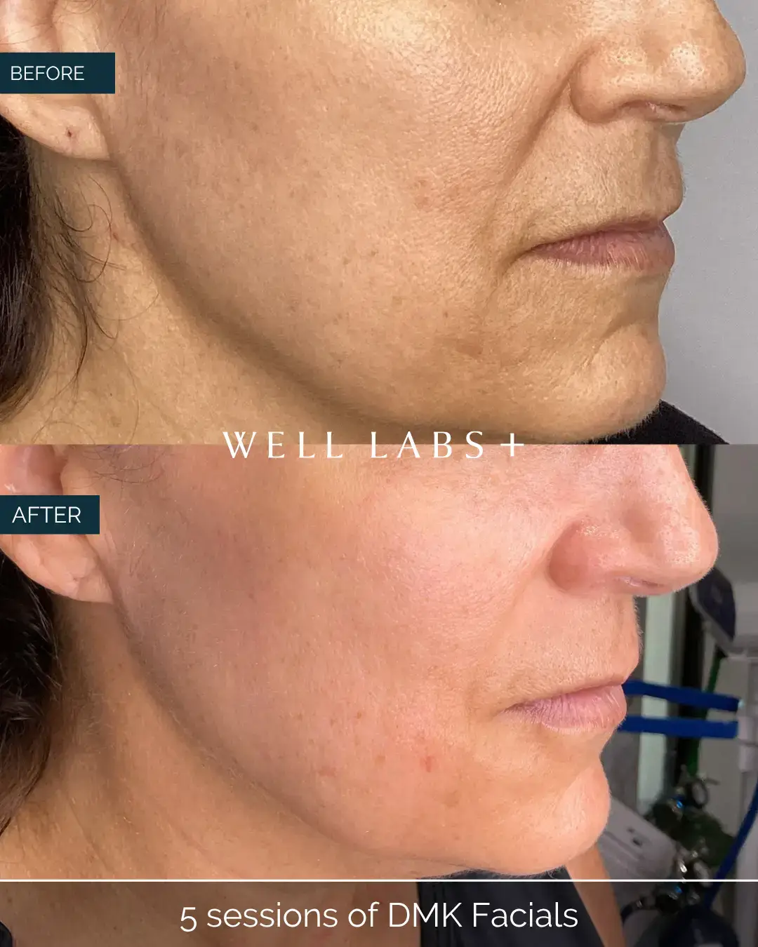Before and after 5 sessions of DMK Facials at Well Labs+ Dallas, showing the treated cheeks