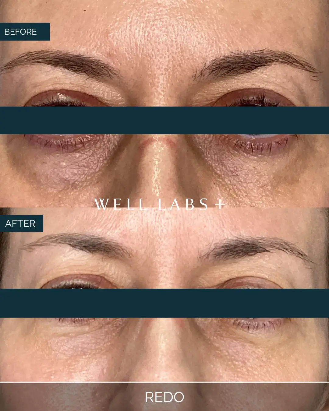 Before and after REDO at Well Labs+ Dallas, showing the treated under-eyes