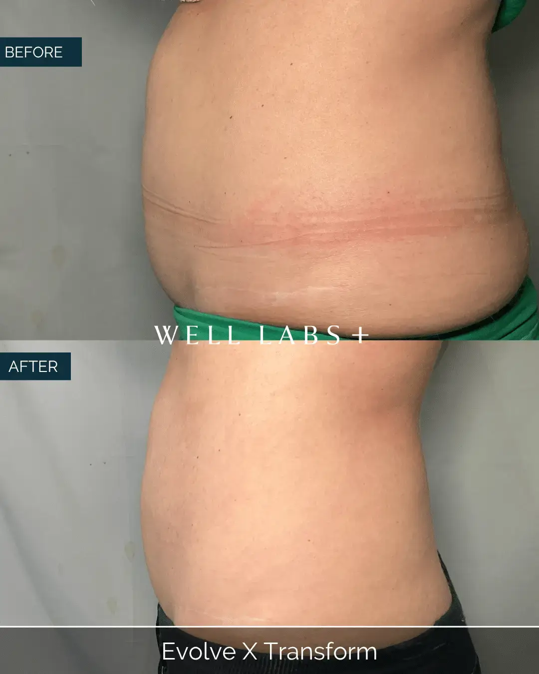 Before and after Evolve X Transform at Well Labs+ Dallas, showing the treated abdomen