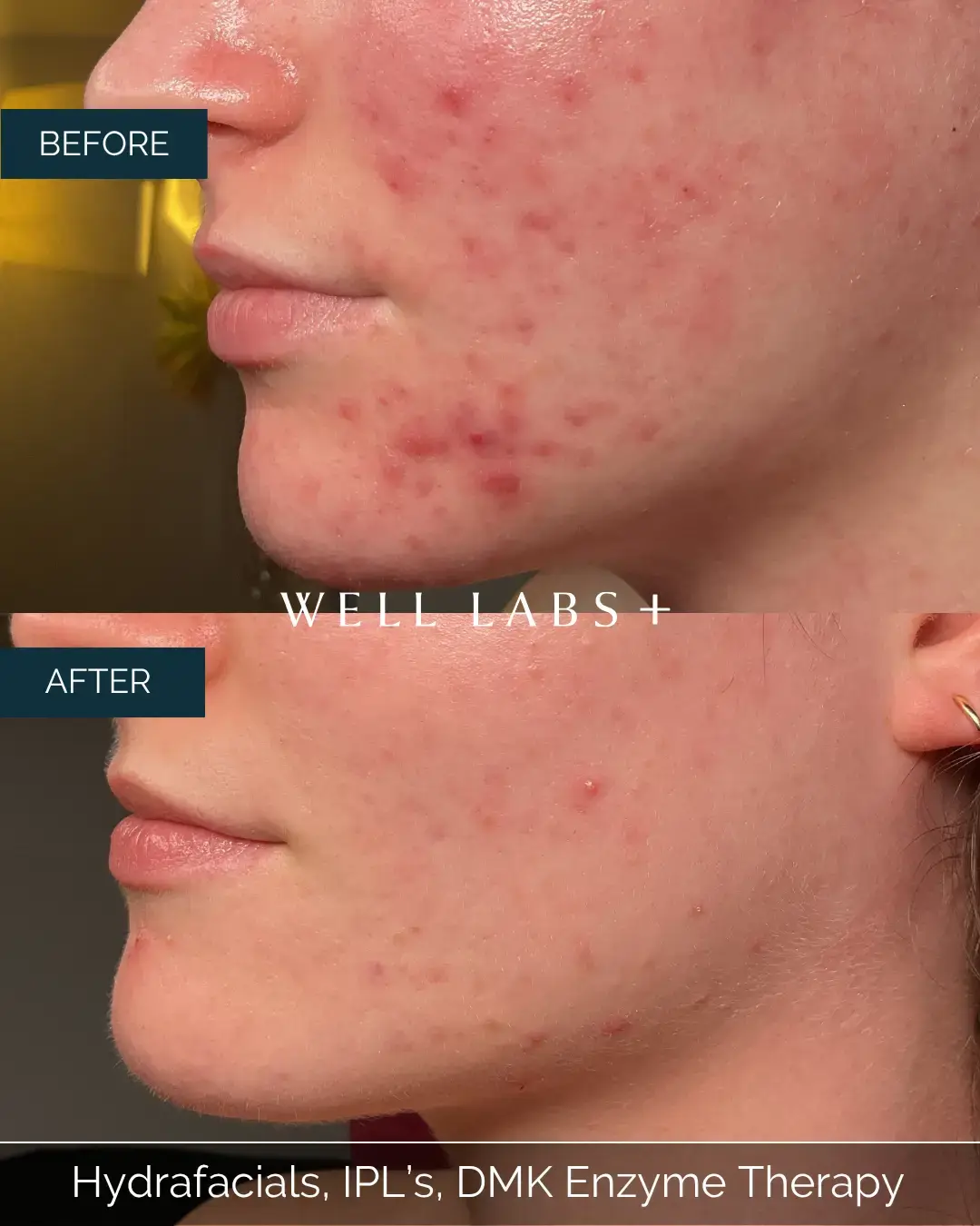 Before and after Hydrafacials, IPL's, DMK Enzyme Therapy at Well Labs+ Dallas, showing the treated cheeks