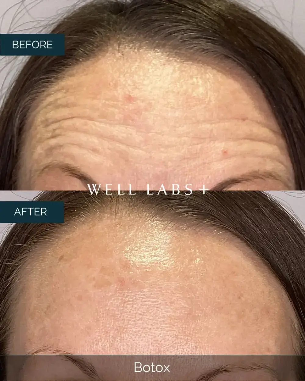 Before and after Botox at Well Labs+ Dallas, showing the treated forehead