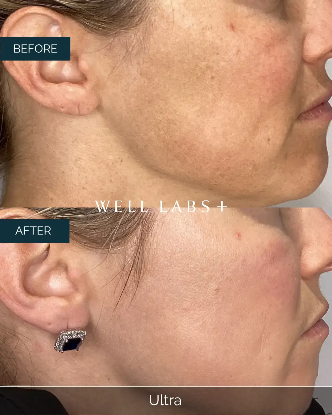 Before and after Ultra at Well Labs+ Dallas, showing the treated cheeks