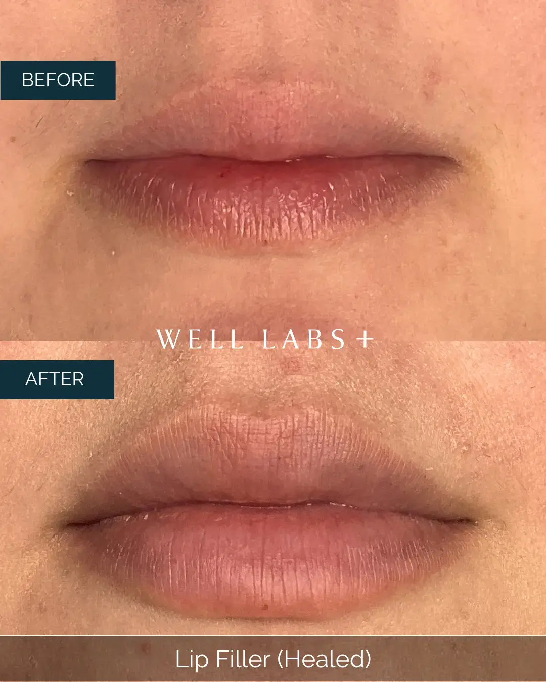 Before and after Lip Filler (Healed) at Well Labs+ Dallas, showing the treated lips