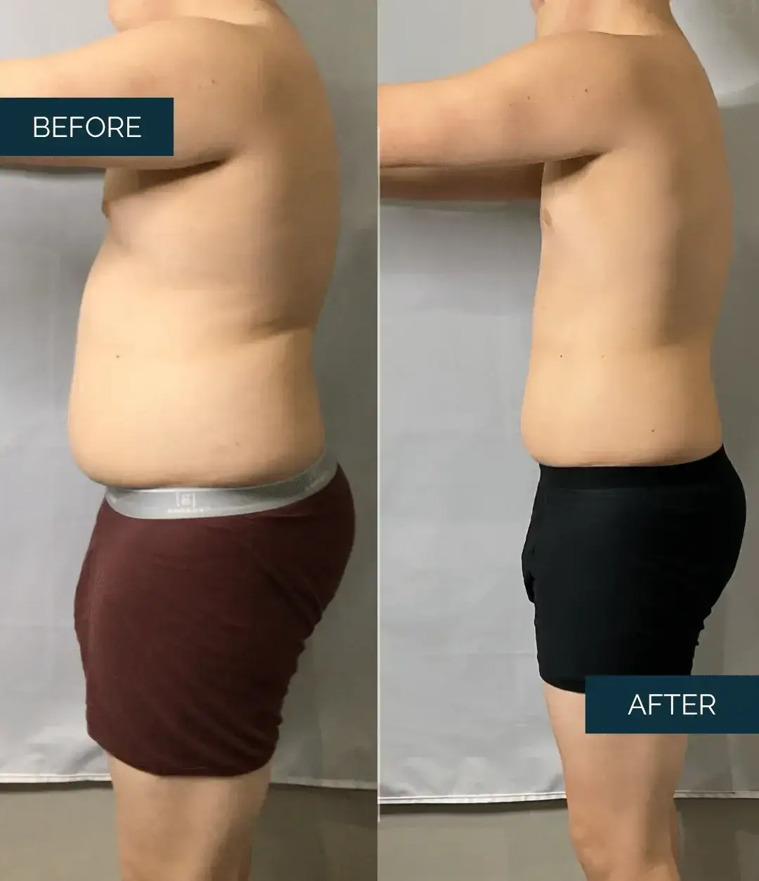Before and after Medical Weight Loss at Well Labs+ Dallas, showing the treated abdomen
