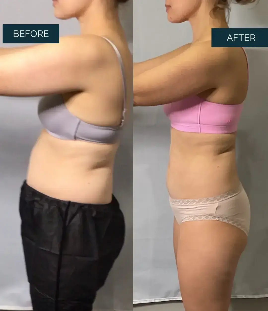 Before and after Medical Weight Loss at Well Labs+ Dallas, showing the treated abdomen