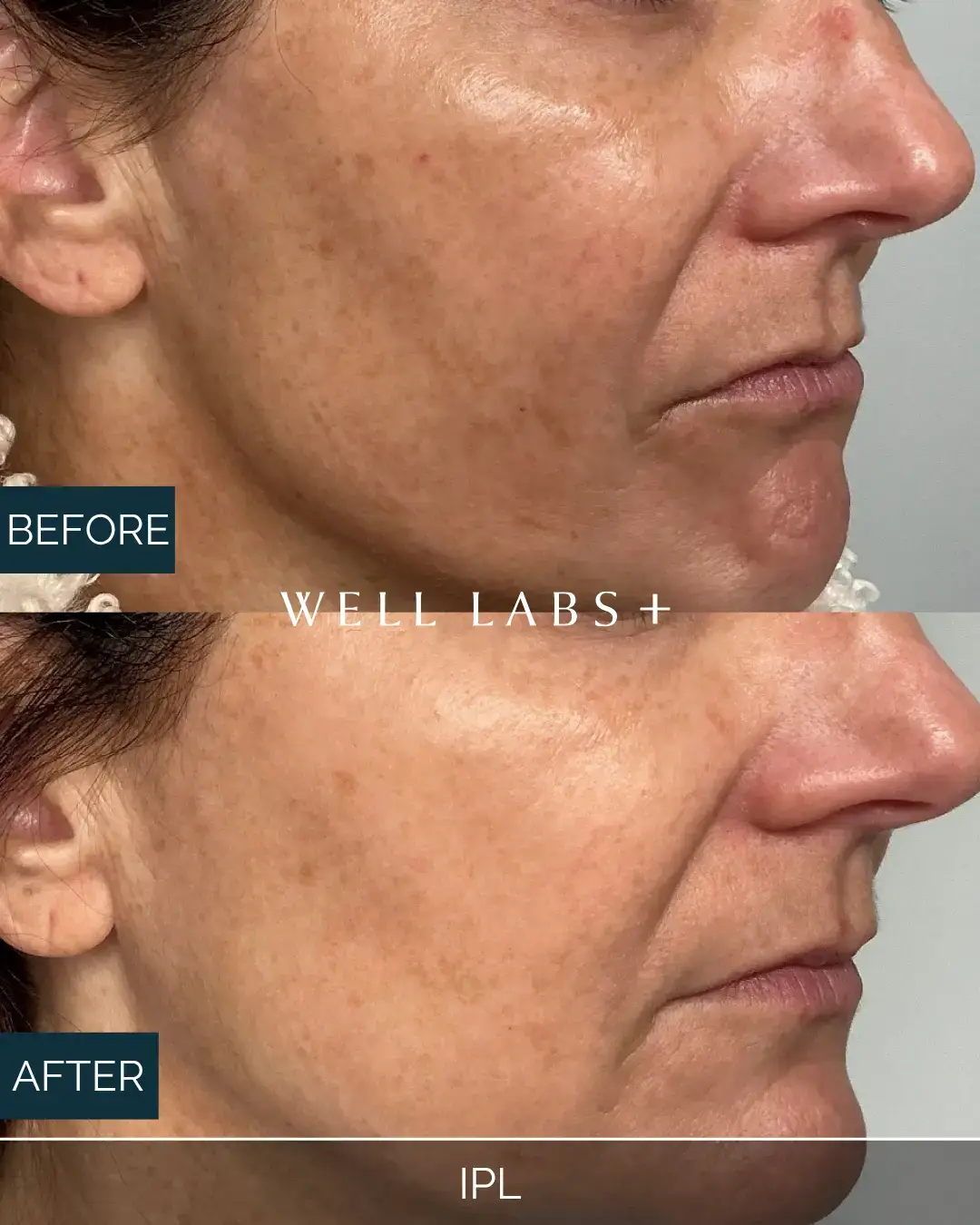 Before and after IPL at Well Labs+ Dallas, showing the treated cheeks