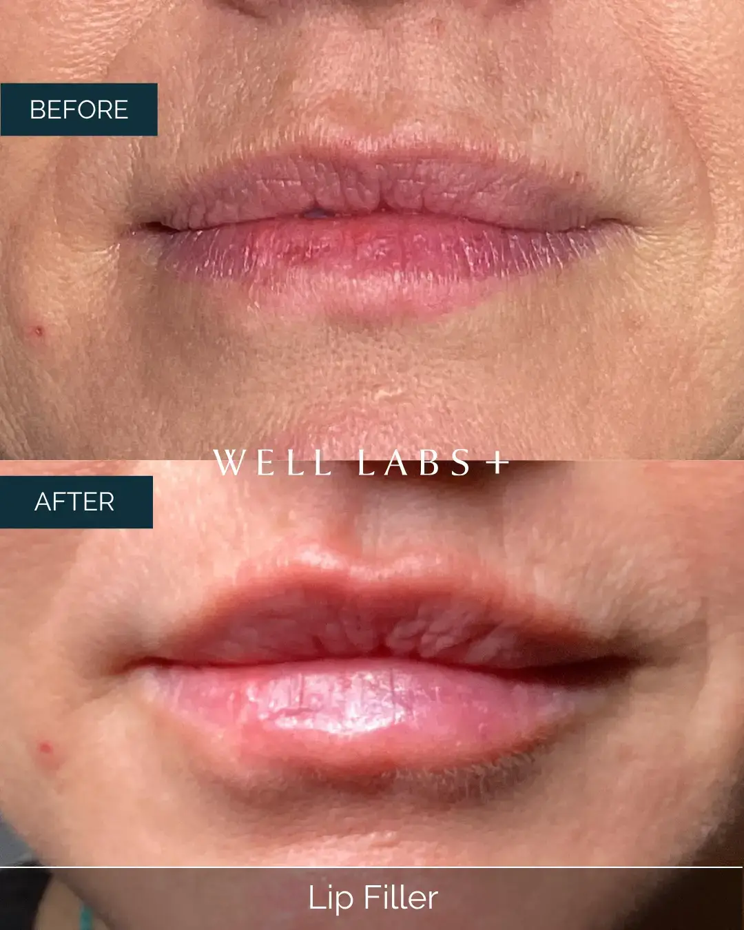 Before and after Lip Filler at Well Labs+ Dallas, showing the treated lips