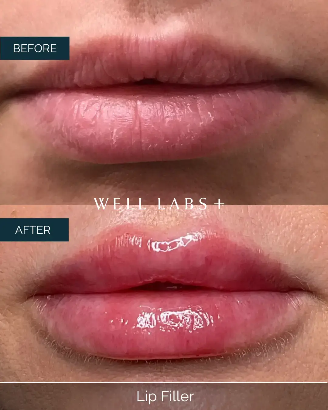 Before and after Lip Filler at Well Labs+ Dallas, showing the treated lips
