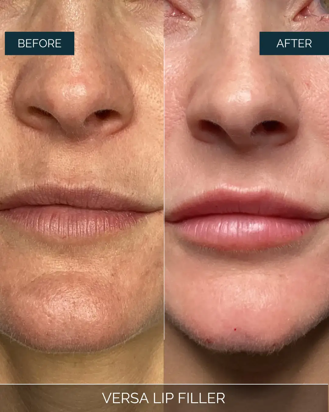 Before and after Versa Lip Filler at Well Labs+ Dallas, showing the treated lips
