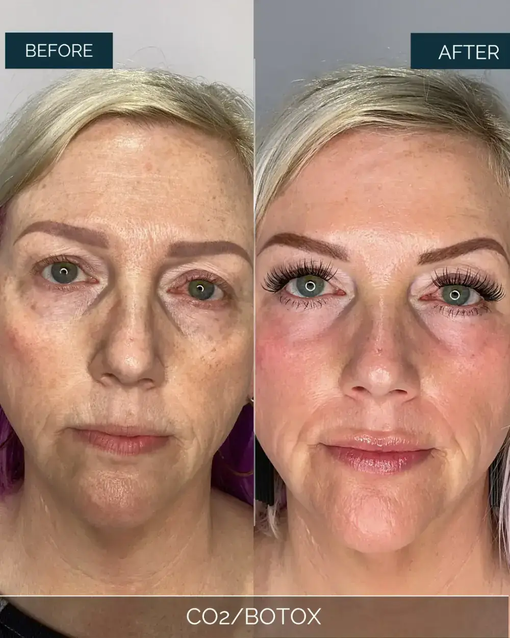 Before and after CO2/BOTOX at Well Labs+ Dallas, showing the treated full face