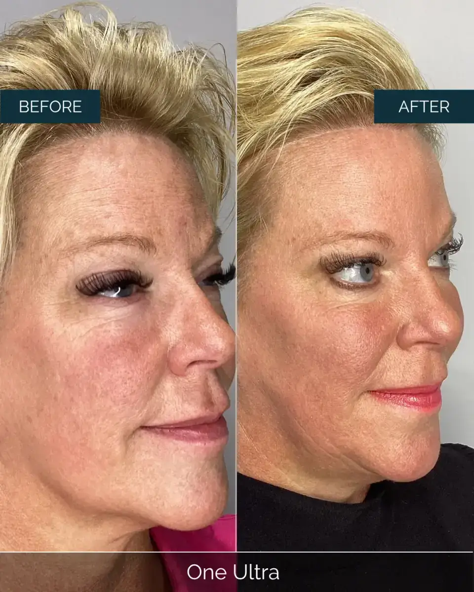 Before and after One Ultra at Well Labs+ Dallas, showing the treated full face