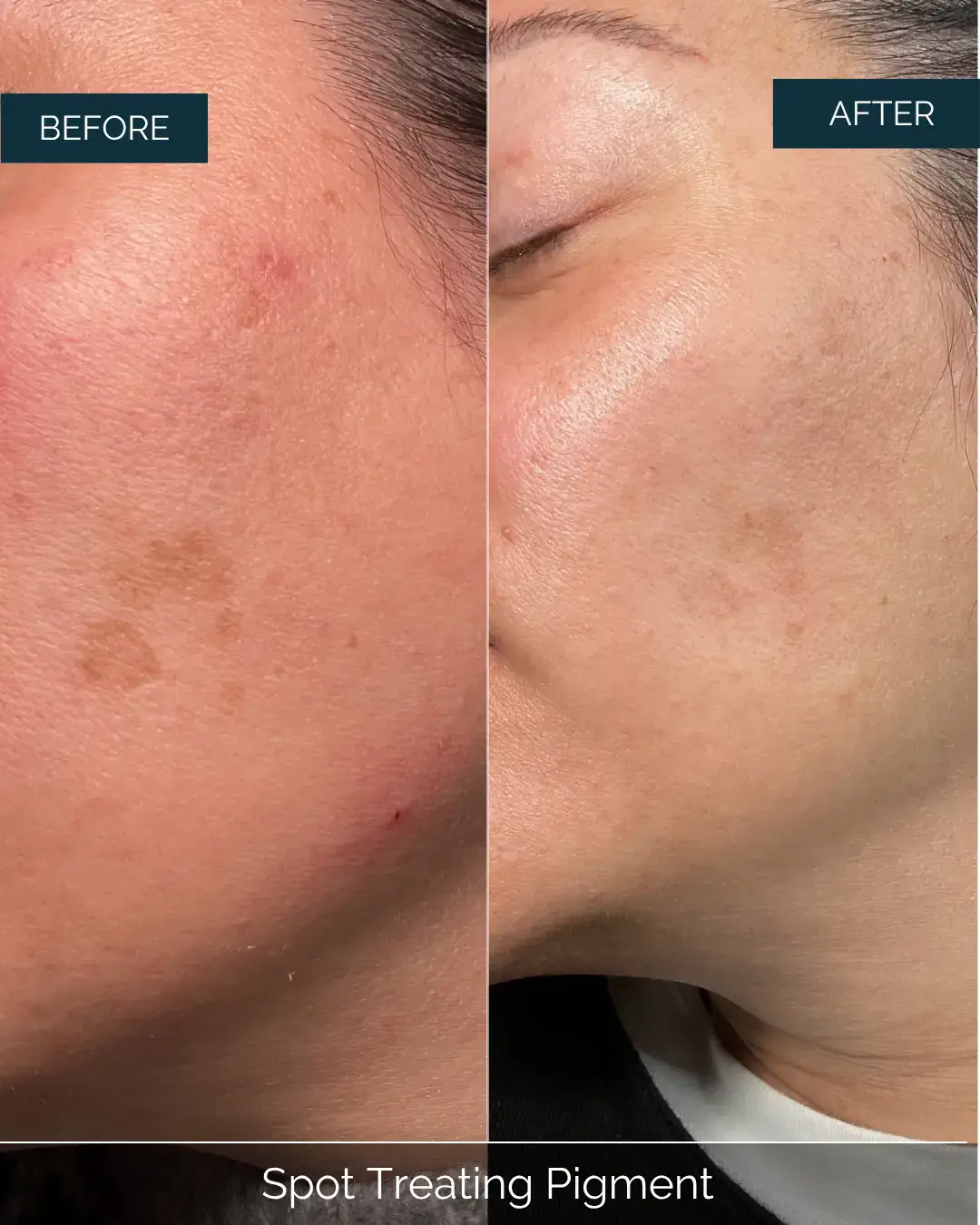 Before and after Spot Treating Pigment at Well Labs+ Dallas, showing the treated cheeks