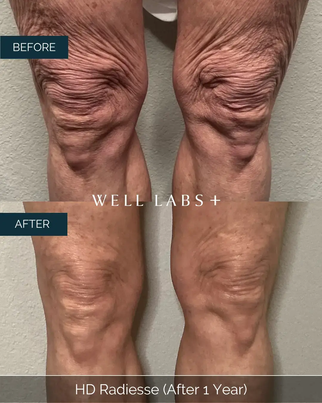 Before and after HD Radiesse (After 1 Year) at Well Labs+ Dallas, showing the treated knees