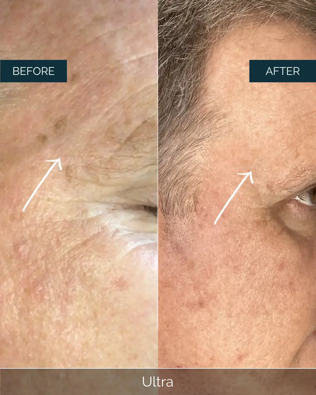 Before and after Ultra at Well Labs+ Dallas, showing the treated forehead