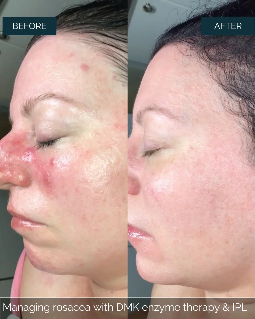 Before and after Managing rosacea with DMK enzyme therapy & IPL at Well Labs+ Dallas, showing the treated face