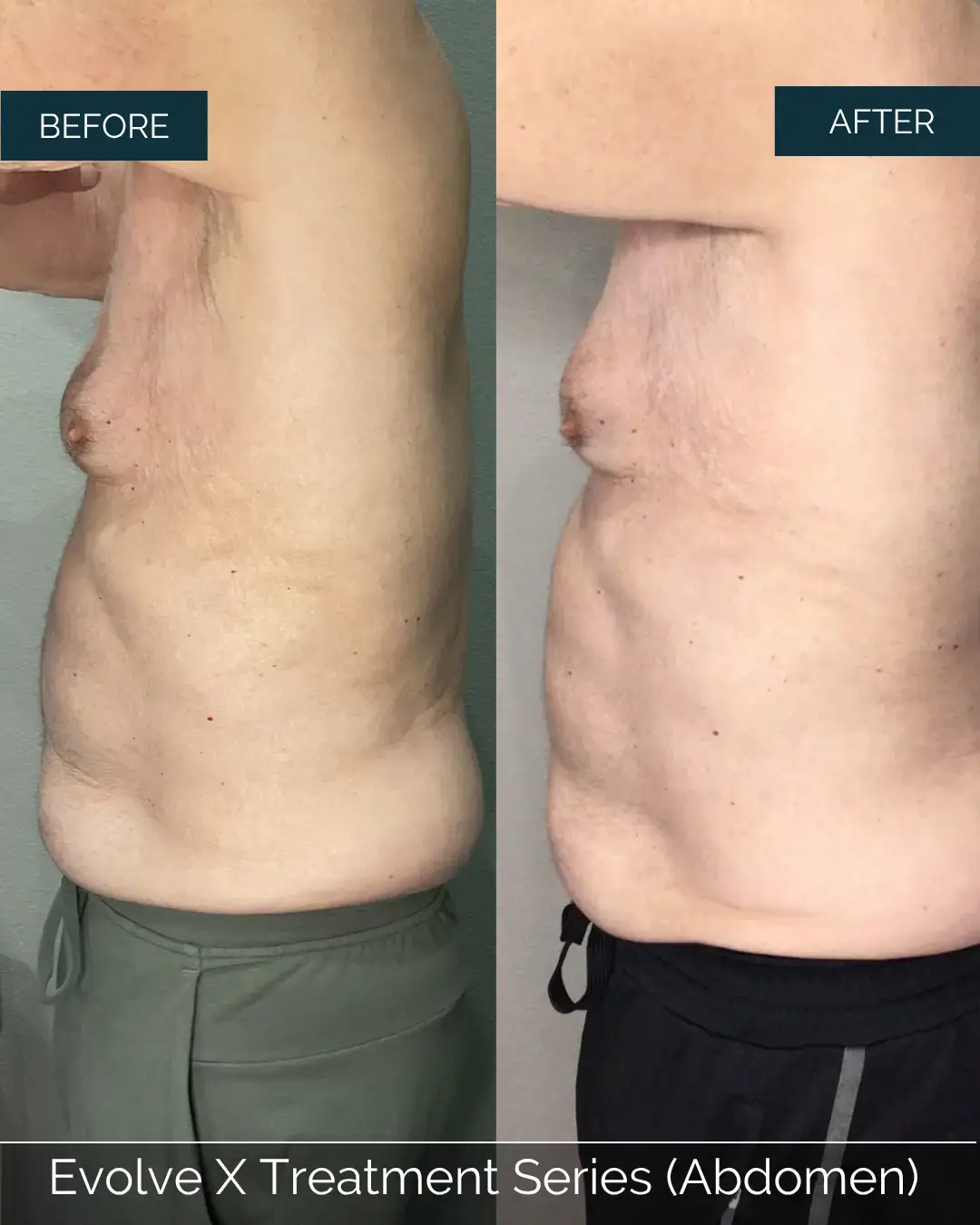 Before and after Evolve X Treatment Series (Abdomen) at Well Labs+ Dallas, showing the treated abdomen