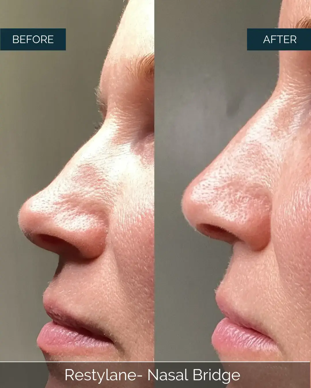 Before and after Restylane- Nasal Bridge at Well Labs+ Dallas, showing the treated nose