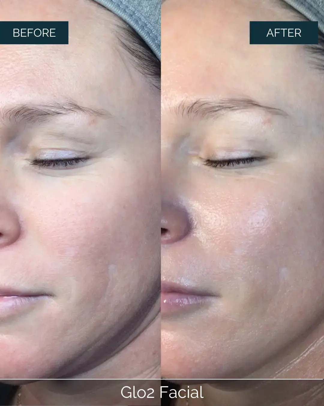 Before and after Glo2 Facial at Well Labs+ Dallas, showing the treated full face