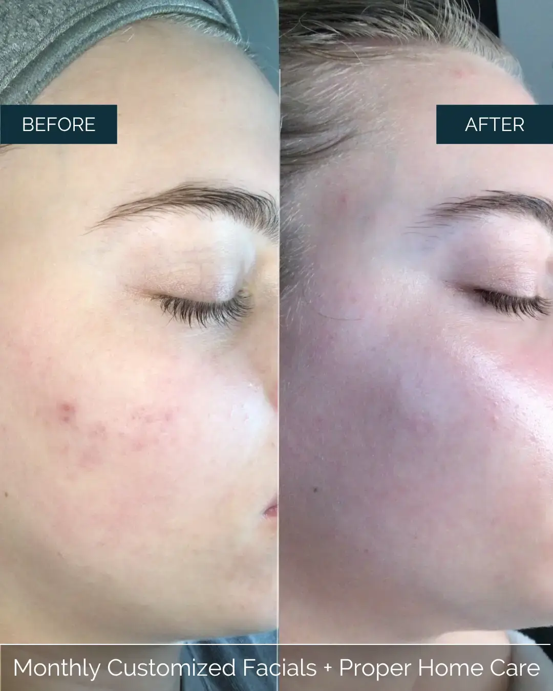 Before and after Monthly Customized Facials + Proper Home Care at Well Labs+ Dallas, showing the treated face