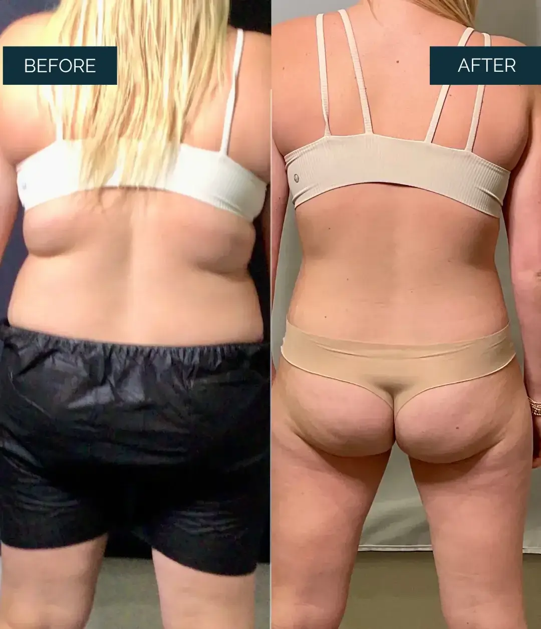 Before and after Medical Weight Loss at Well Labs+ Dallas, showing the treated full body