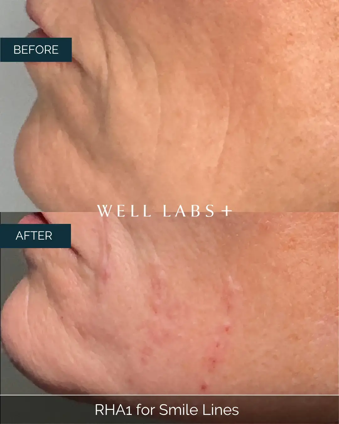Before and after RHA1 for Smile Lines at Well Labs+ Dallas, showing the treated nasolabial folds