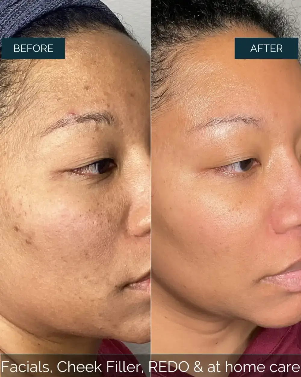 Before and after Facials, Cheek Filler, REDO & at home care at Well Labs+ Dallas, showing the treated cheeks