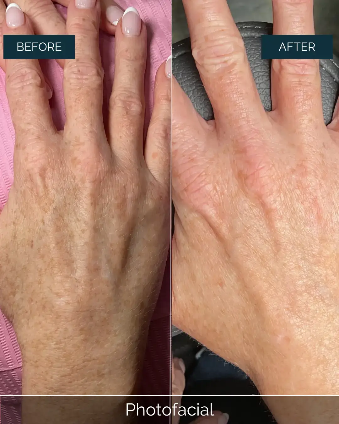 Before and after Photofacial at Well Labs+ Dallas, showing the treated hands