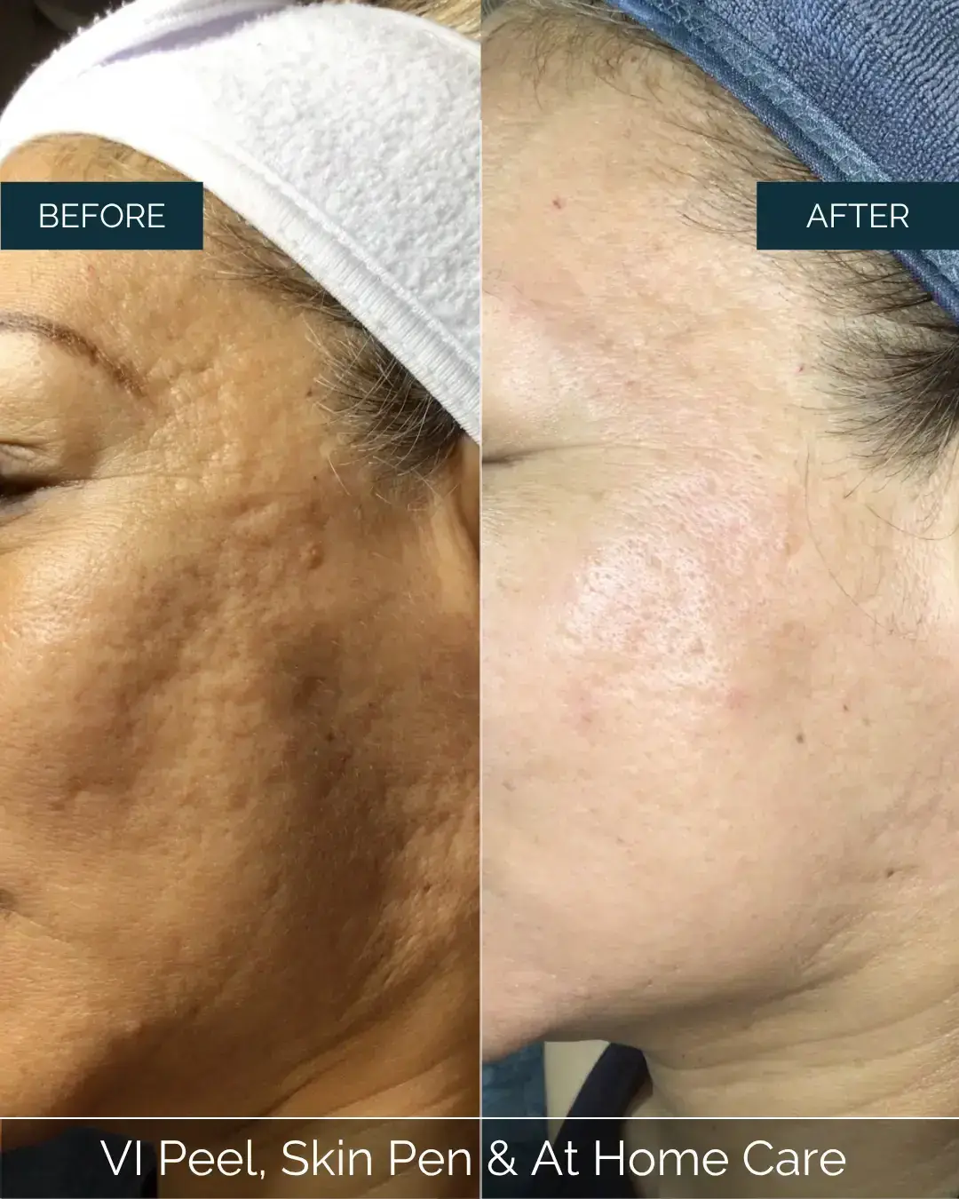 Before and after VI Peel, Skin Pen & At Home Care at Well Labs+ Dallas, showing the treated cheeks and forehead