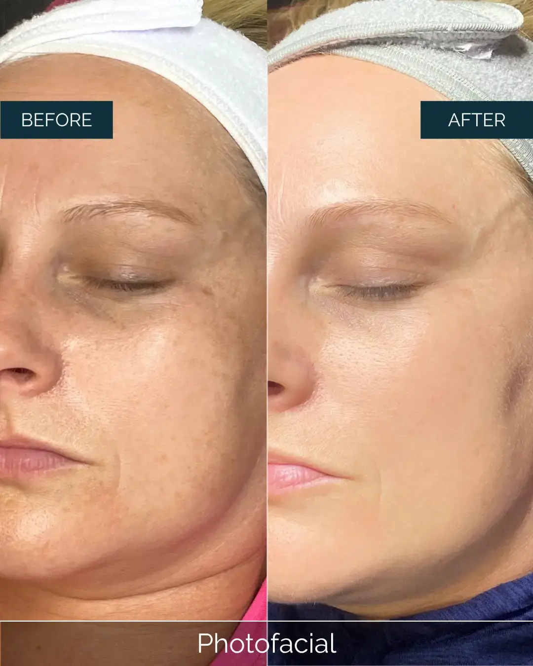 Before and after Photofacial at Well Labs+ Dallas, showing the treated face