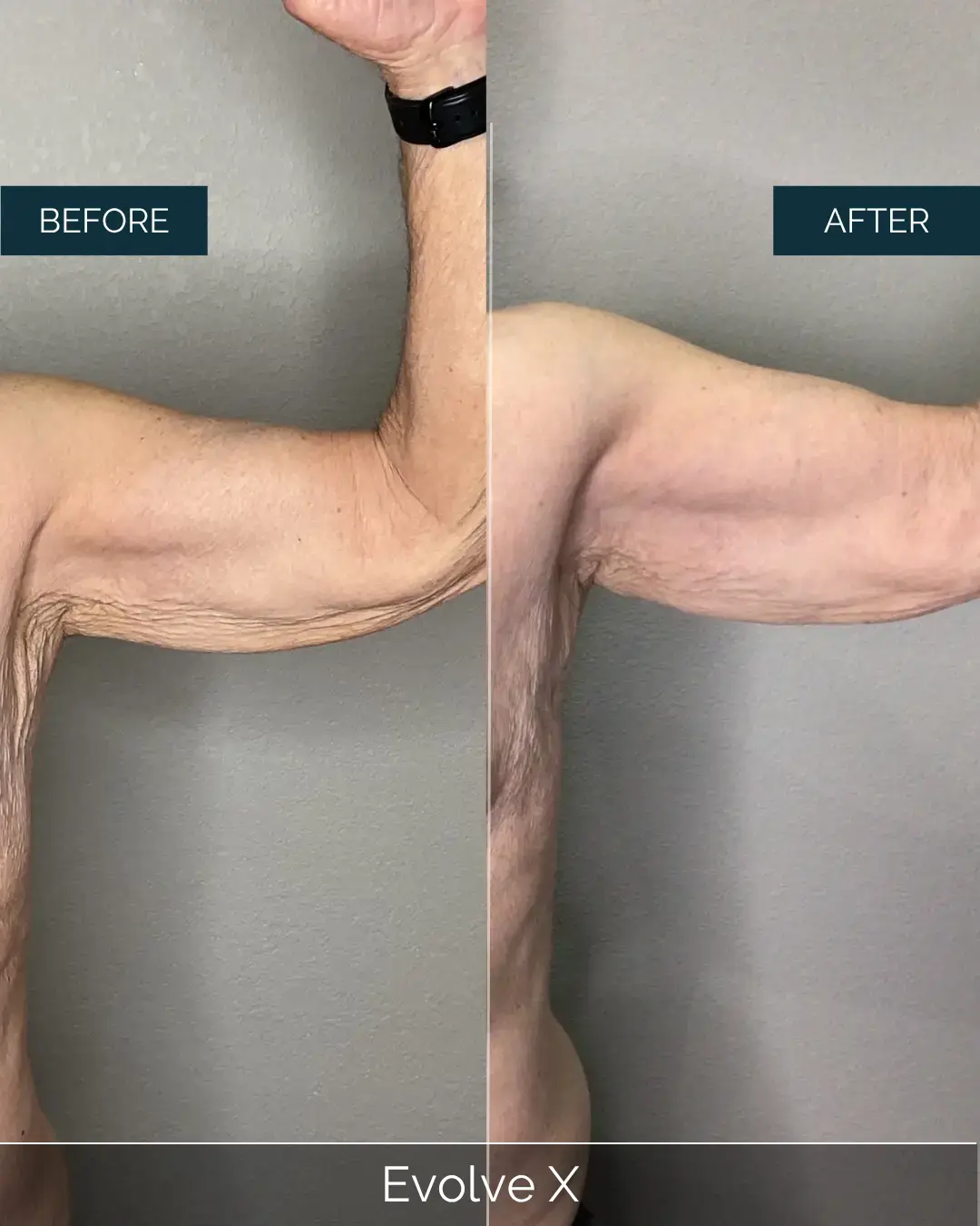 Before and after Evolve X at Well Labs+ Dallas, showing the treated arm