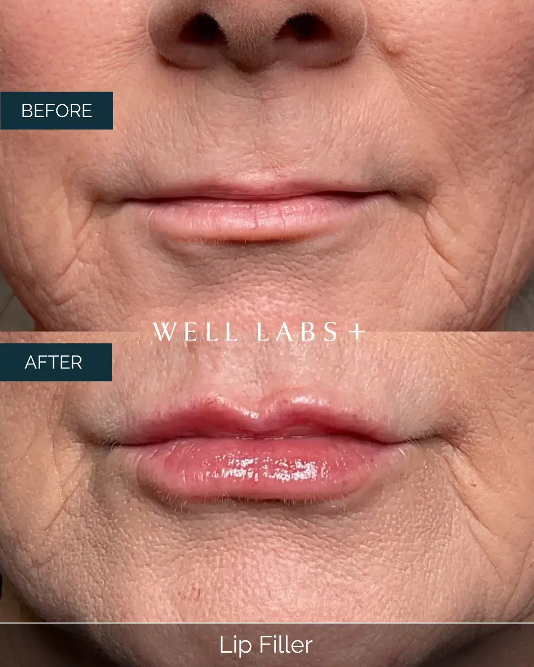 Before and after Lip Filler at Well Labs+ Dallas, showing the treated lips