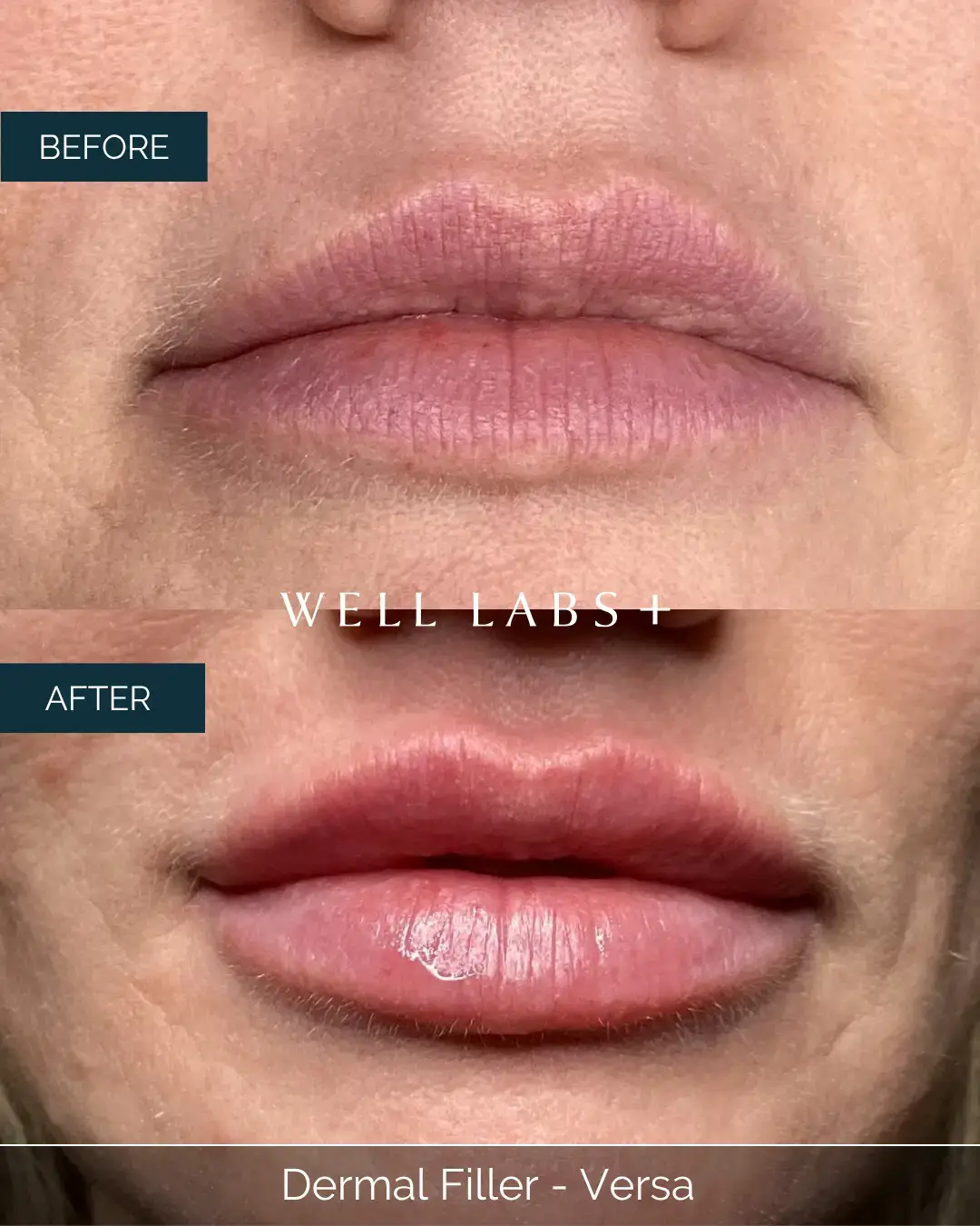 Before and after Dermal Filler - Versa at Well Labs+ Dallas, showing the treated lips