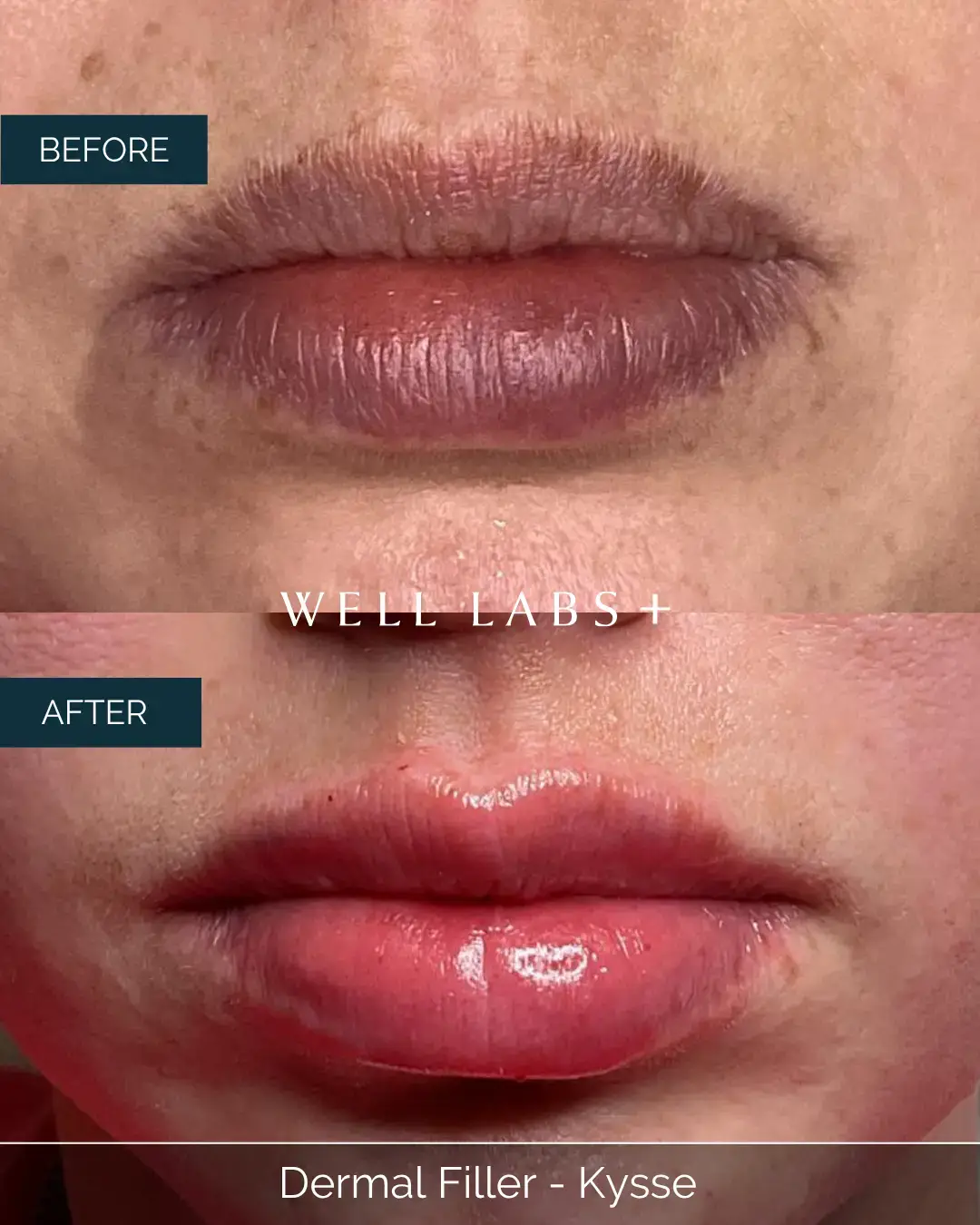 Before and after Dermal Filler - Kysse at Well Labs+ Dallas, showing the treated lips