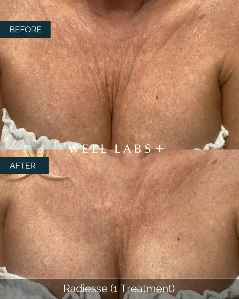 Before and after Radiesse (1 Treatment) at Well Labs+ Dallas, showing the treated chest