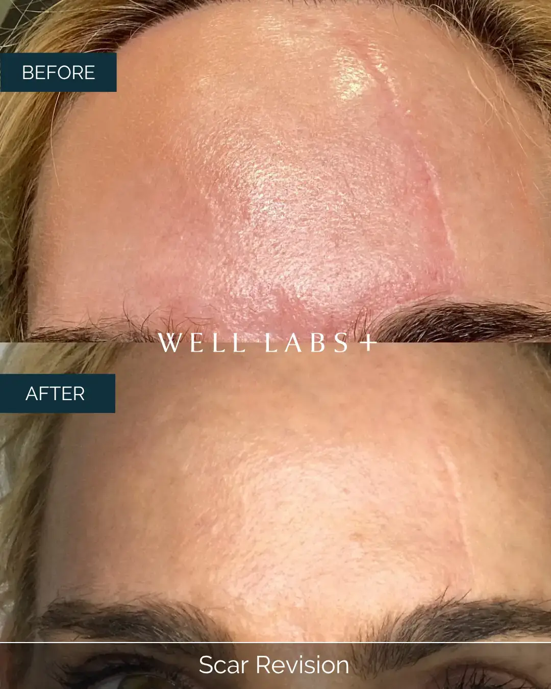 Before and after Scar Revision at Well Labs+ Dallas, showing the treated forehead