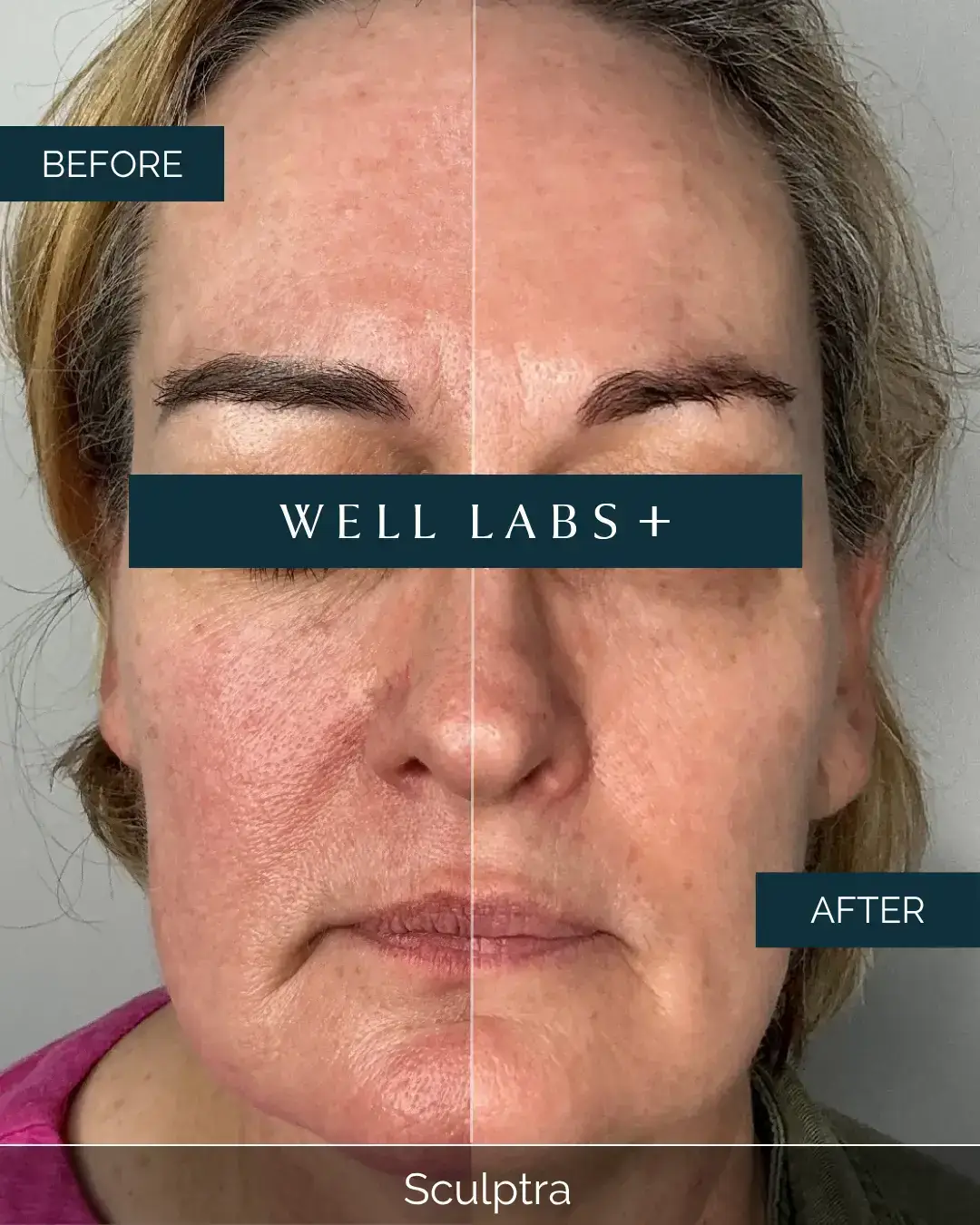 Before and after Sculptra at Well Labs+ Dallas, showing the treated full face