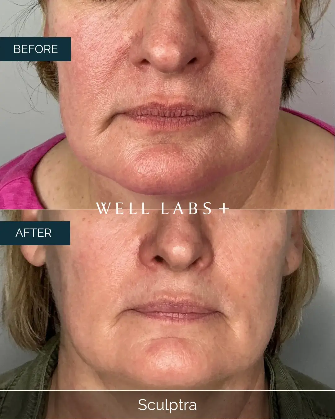 Before and after Sculptra at Well Labs+ Dallas, showing the treated full face