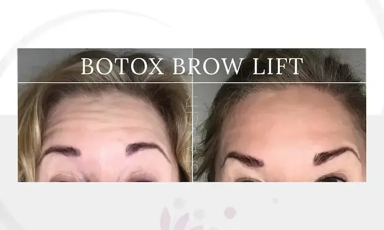 Lifted Brows Without Surgery All About a Botox Brow Lift in Dallas