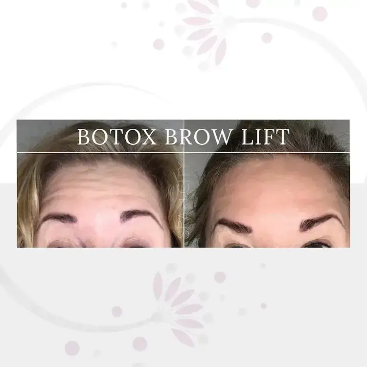 Lifted Brows Without Surgery All About a Botox Brow Lift in Dallas