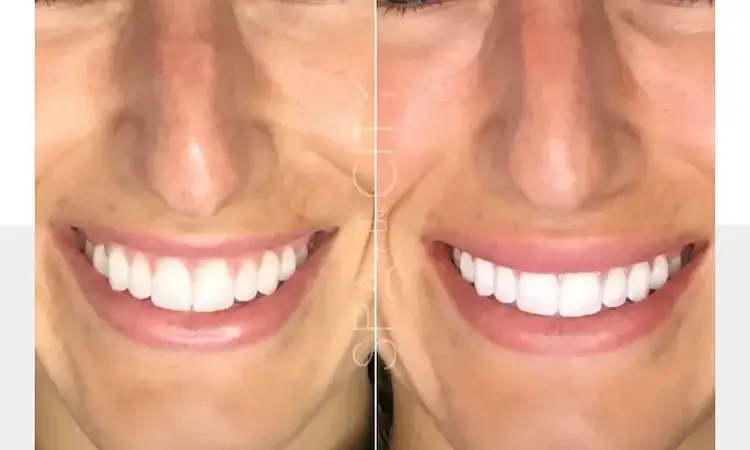 Botox Lip Flip in Dallas for a Natural Lip Boost