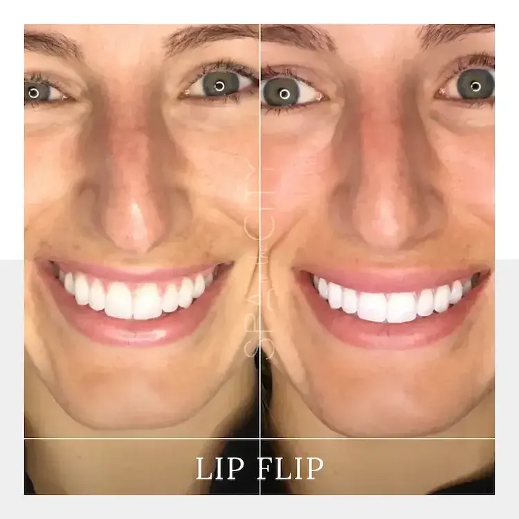 Botox Lip Flip in Dallas for a Natural Lip Boost