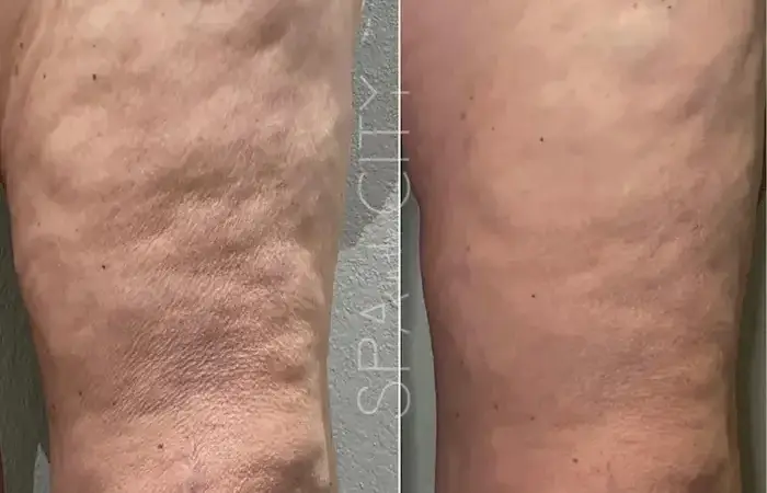 Cellulite Treatments That Work Proven by Dallas Aesthetic Experts